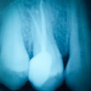 dental tooth x-ray film of root canal therapy