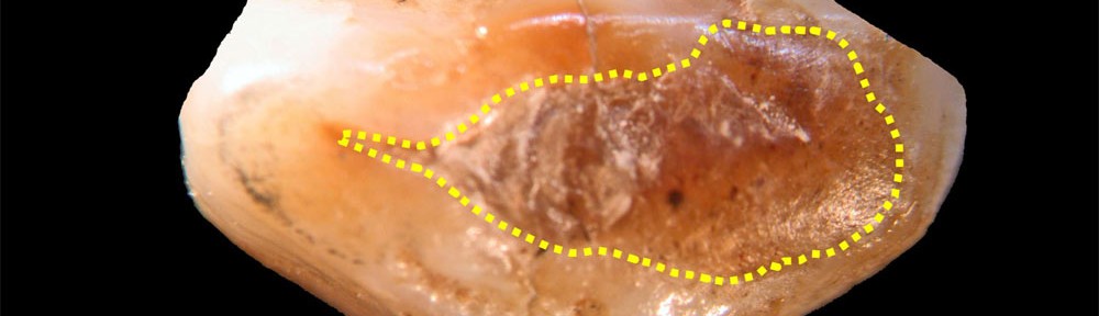 ancient tooth filling