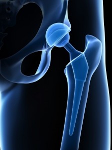 3d rendered illustration of a hip replacement