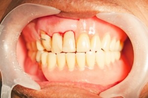Dental prosthesis for upper denture in mouth