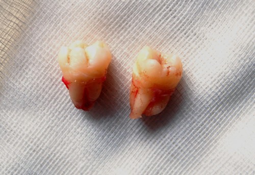 Wisdom_teeth