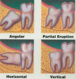 wisdom tooth chart