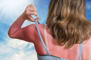 Sunburn concept. Young woman with red sunburned skin on her back